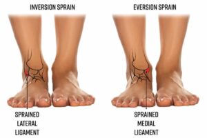 ankle pain