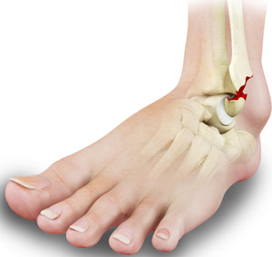 ankle pain